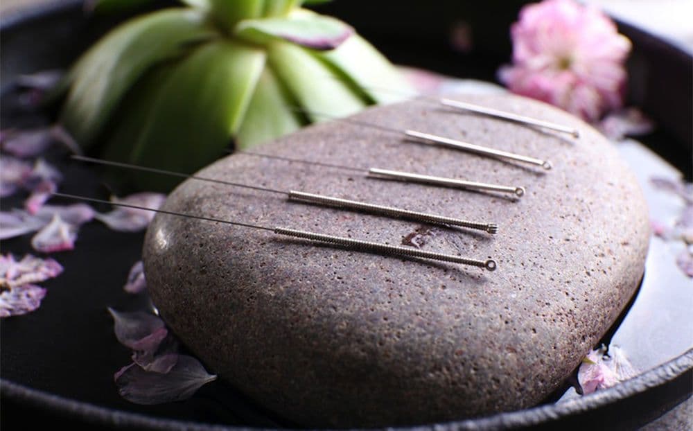 علاج الوخز بالإبر حقيقة أم وهم؟