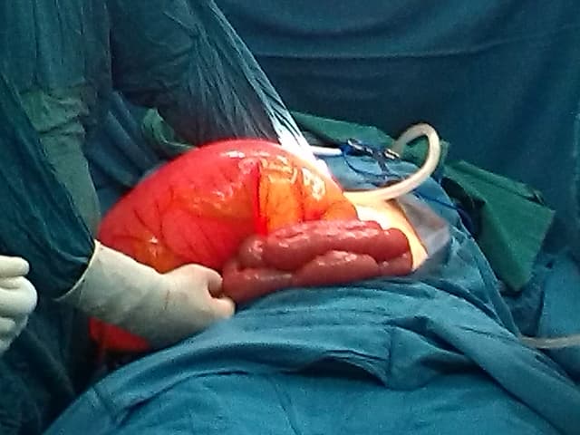 الانفتال: ما أسباب هذه الحالة الخطيرة؟ وكيف تُعالج؟