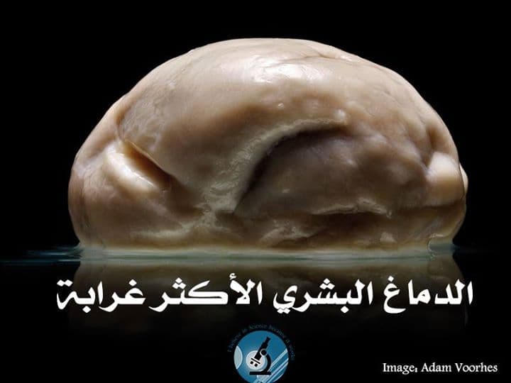 هذا هو الدّماغ البشري الأكثر غرابة