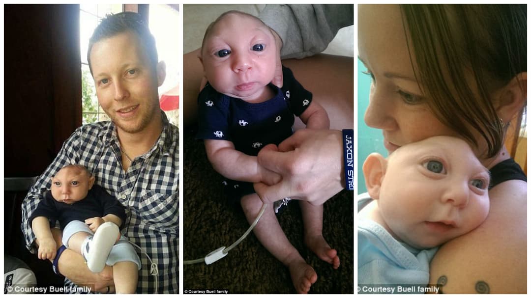 ما هي حالة انعدام الدماغ ؟