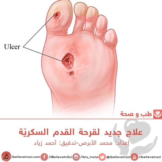 علاج جديد لقرحة القدم السكريّة