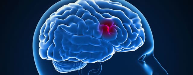 اكتشاف نوع جديد من الجزيئات يمكن أن يحمي من السكتة الدماغية