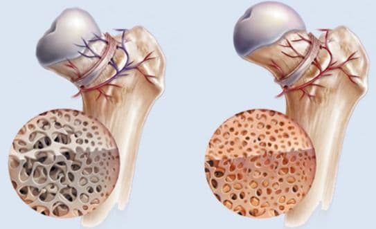 التنخر العظمي Osteonecrosis