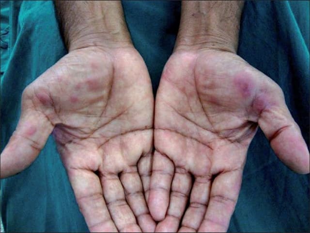 الحمامى المرتفعة الدائمة: الأسباب والاعراض والتشخيص والعلاج