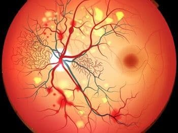اعتلال الشبكية السكري: الأسباب والأعراض والتشخيص والعلاج
