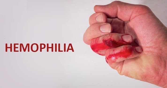 الناعور A أو الهيموفيليا A: الأسباب والأعراض والتشخيص والعلاج