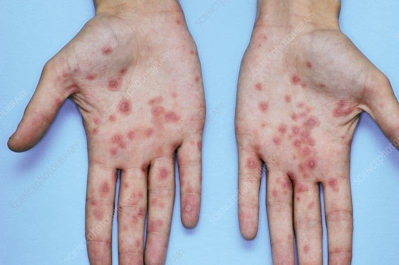 الحمامى عديدة الأشكال: الأسباب والأعراض والتشخيص والعلاج