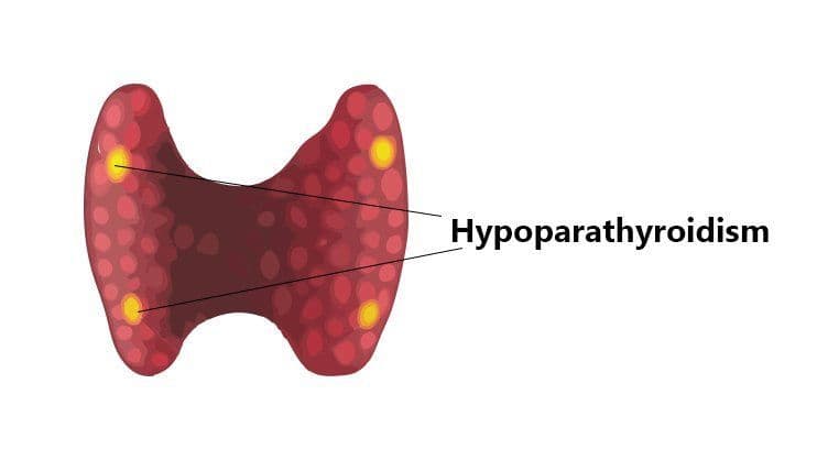 قصور الدريقات: الأسباب والأعراض والتشخيص والعلاج