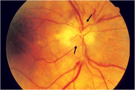 الاعتلال العصبي البصري الأمامي AION: الأسباب والأعراض والتشخيص والعلاج