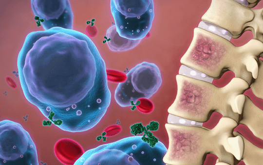 الورم النقوي المتعدد: الأسباب والأعراض والتشخيص والعلاج