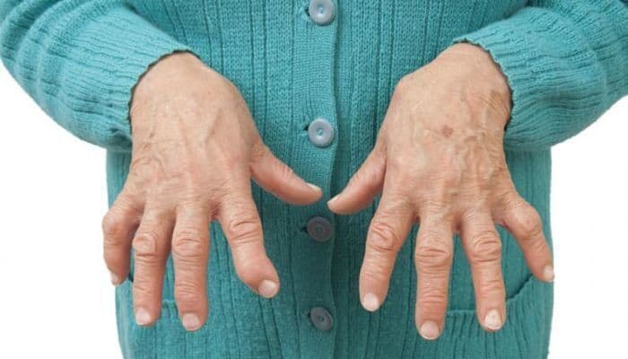 داء باجيت Paget's disease: الأسباب والأعراض والتشخيص والعلاج