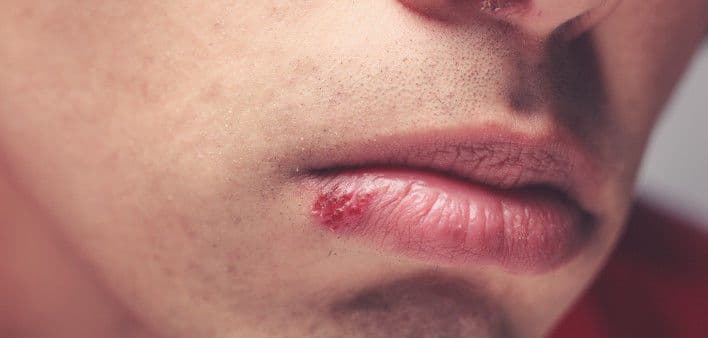 عشر خرافات عن الهربس التناسلي