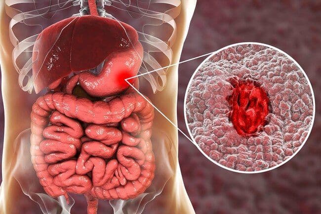 القرحة الهضمية Stomach (Peptic) Ulcers