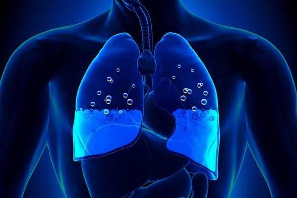 وذمة الرئة: الأسباب والأعراض والتشخيص والعلاج