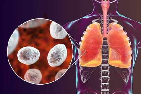 الالتهاب الرئوي بالمتكيسة الجؤجؤية