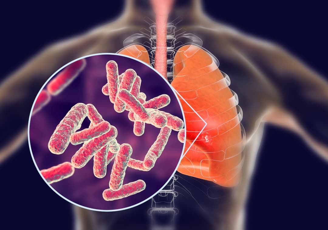 السل الرئوي: الأسباب والأعراض والتشخيص والعلاج