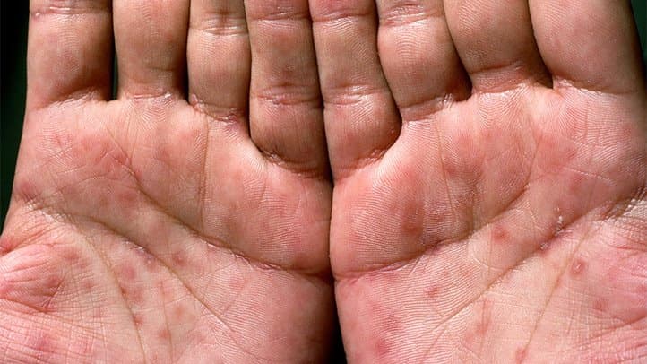 تجارب السفلس في غواتيمالا
