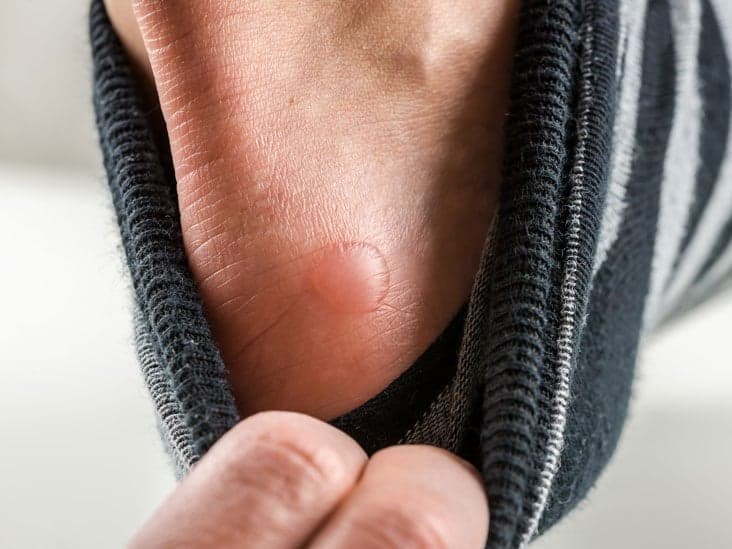 كل ما تريد أن تعرفه عن فقاعات القدمين