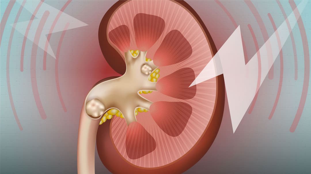حصى الكلى: الأسباب والأعراض وطرق العلاج