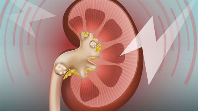 حصى الكلى: الأسباب والأعراض وطرق العلاج