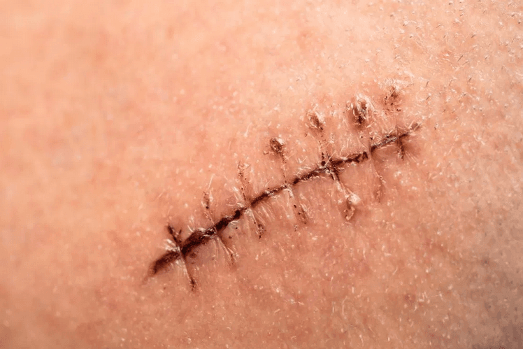 القطب أو الغرز القابلة للذوبان: ما استخداماتها؟ وهل هي أفضل من القطب العادية؟