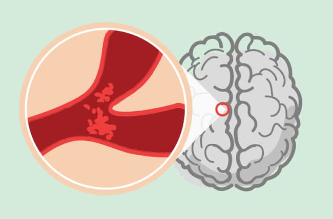 خمس عادات صحية للوقاية من الإصابة بسكتة دماغية ثانية