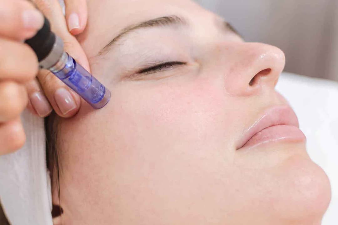 ما هو علاج تحفيز الكولاجين (الإبر المجهرية)؟