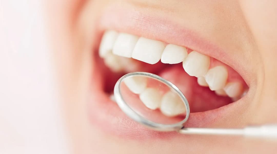 مرض القلاع: الأسباب والتشخيص والعلاج