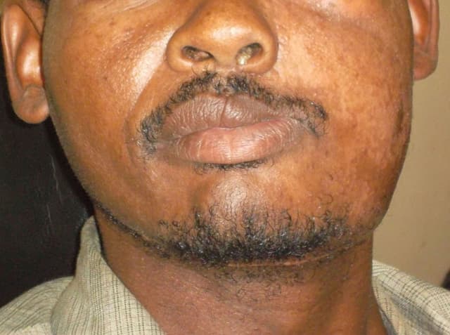 الورم الأرومي المينائي (أميلوبلاستوما): الأسباب والأعراض والتشخيص والعلاج