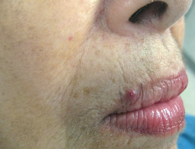 الورم الوعائي العصوي: الأسباب والأعراض والتشخيص والعلاج