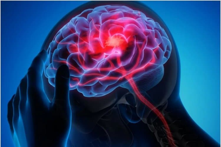 كيف تحدث نوبات الصرع ولماذا يصعب تشخيصها؟