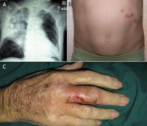 الراعوم أو داء وايتمور: الأسباب والأعراض والتشخيص والعلاج