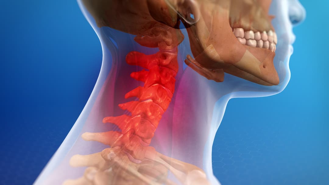 الإصابة المصعية (إصابة الرقبة المفاجئة): الأسباب والأعراض والتشخيص والعلاج