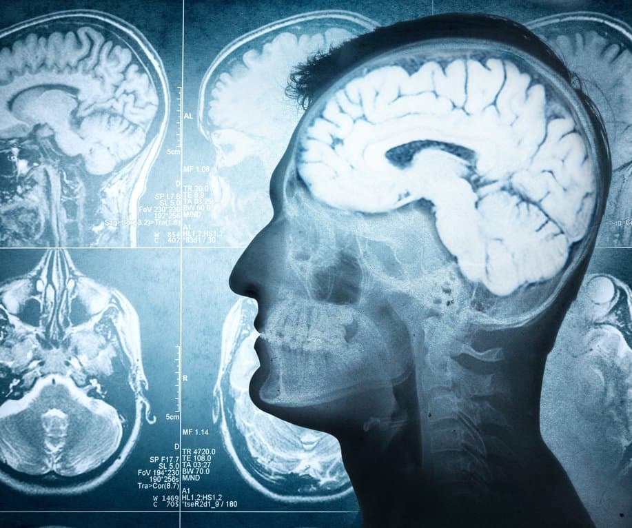 غرسة في الدماغ تسمح لمريض مصاب بالشلل التام بالتواصل مع محيطه