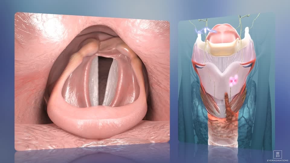 شلل الحبل الصوتي: الأسباب والأعراض والتشخيص والعلاج