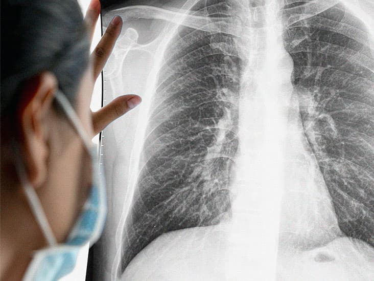 سرطان الخلايا الصغيرة الرئوي: الأسباب والأعراض والتشخيص والعلاج