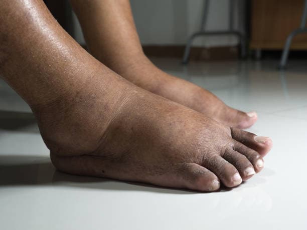 متلازمة أجيناس: الأسباب والأعراض والتشخيص والعلاج