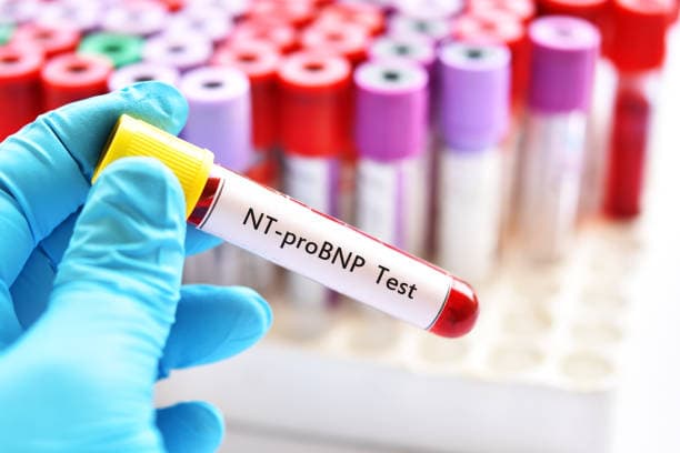 اختبار الببتيدات المدرة للصوديوم نمط ب (تحليل BNP): تفاصيل التحليل والنتائج