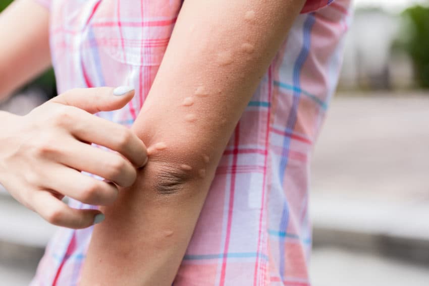 هل يمكن أن نصاب بحساسية من الطقس البارد؟
