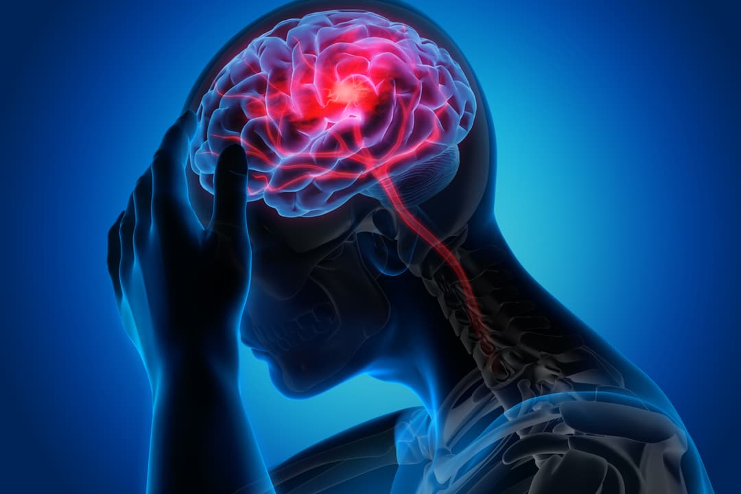 دحض الخرافات الطبية عن السكتة الدماغية
