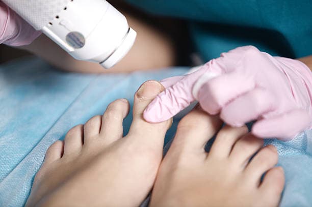 علاج فطور أظفار القدم بالليزر: كيف يعمل ومخاطره