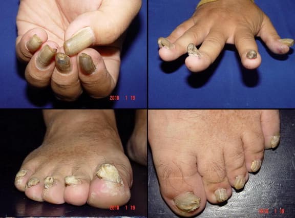 تثخن الأظفار الخلقي (متلازمة ياداسون-ليفاندفسكي)