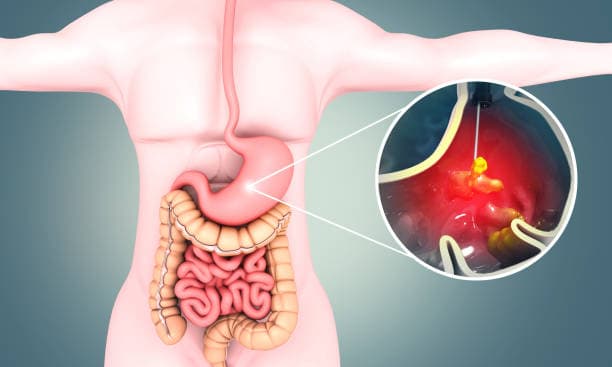 القرحة المعدية: الأسباب والأعراض والتشخيص والعلاج