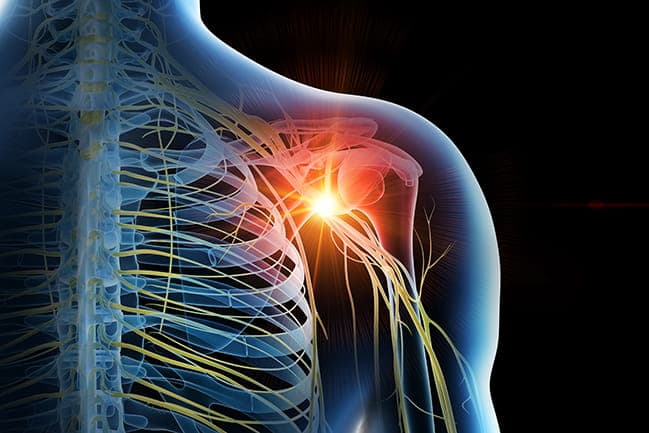 اعتلال أعصاب الضفيرة العضدية: الأسباب والأعراض والتشخيص والعلاج