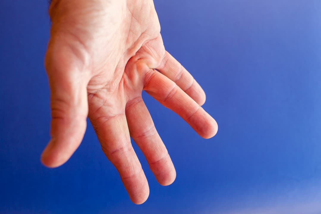 تقلص دوبويتران أو داء الفايكنغ: الأسباب والأعراض والتشخيص والعلاج