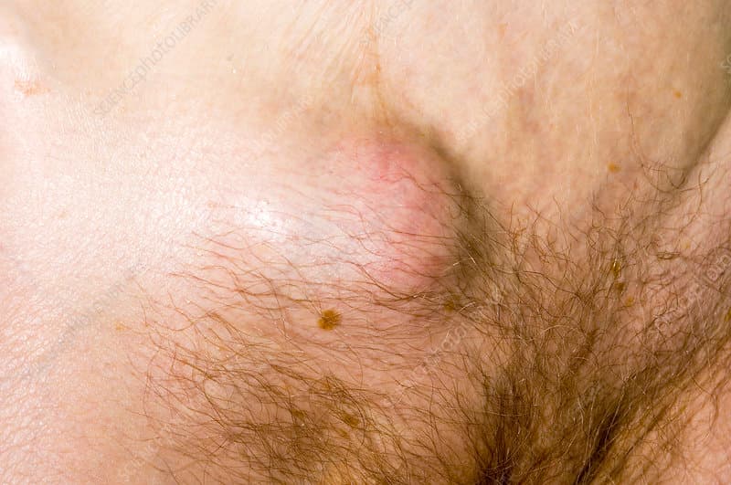 الفتق المختنق: الأسباب والأعراض والتشخيص والعلاج