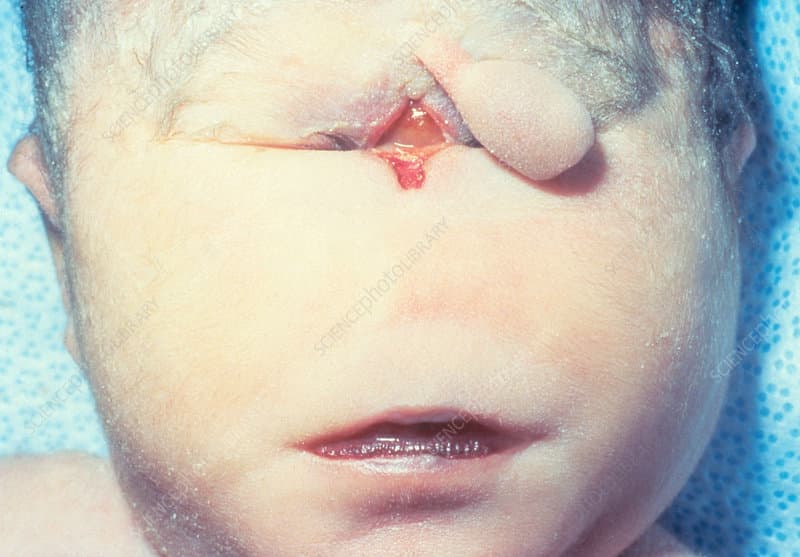 التحام العينين (التصقلب): الأسباب والتشخيص والعلاج