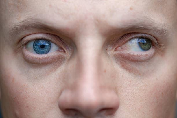 الحَوَل الإنسي: الأسباب والأعراض والتشخيص والعلاج