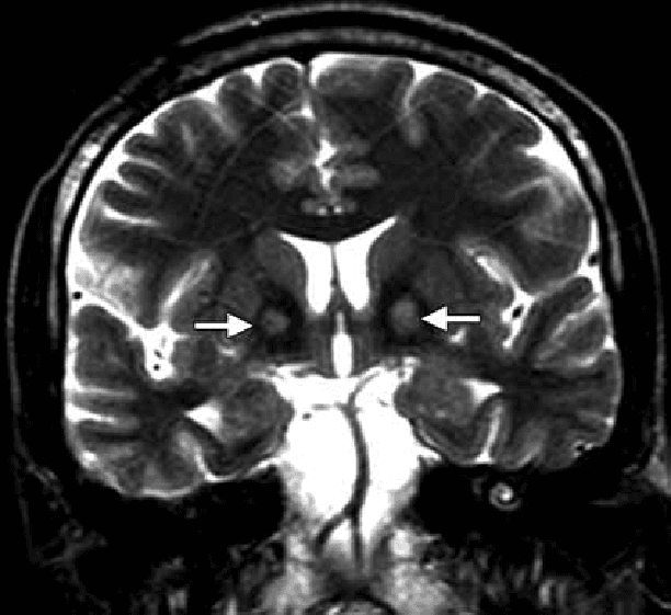 متلازمة هالرفوردن سباتز: الأسباب والأعراض والتشخيص والعلاج