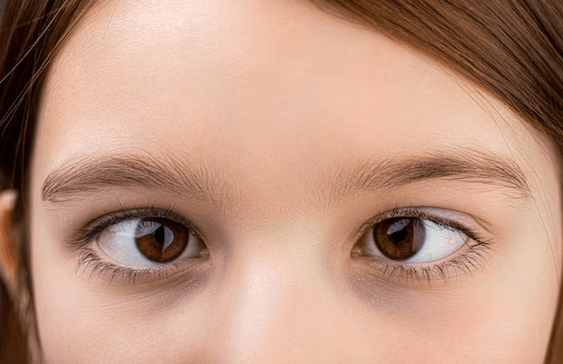 الحول الفوقاني: الأسباب والعلاج